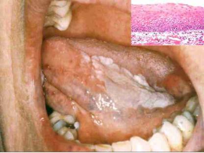 leukoplakie