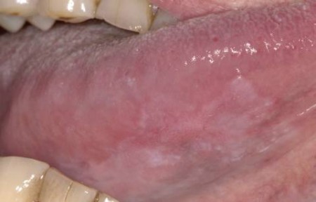 leukoplakie